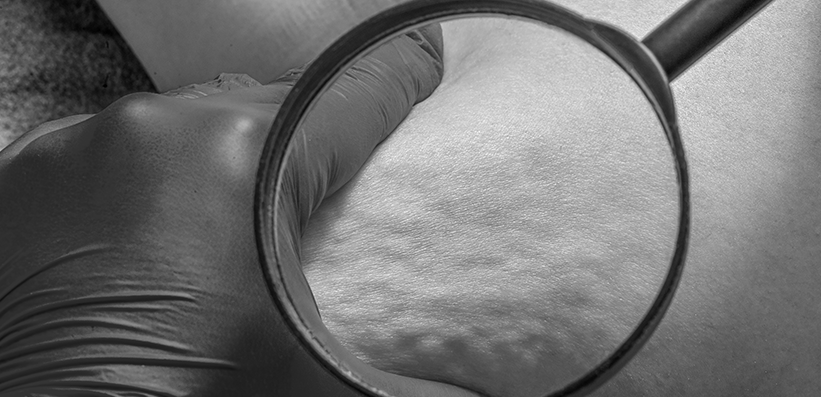 Clinical Improvement in Leg Cellulitis Is Slow